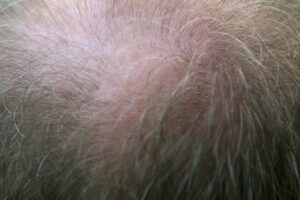 hair balding head