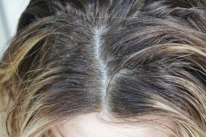 dry scalp and dandruff